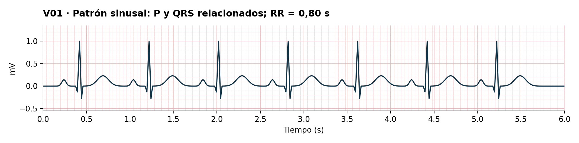 V01 · Patrón sinusal: P y QRS relacionados; RR = 0,80 s